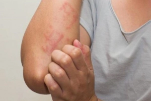 12 cách tự nhiên để “đánh bại” dị ứng