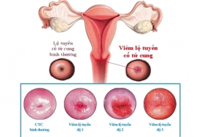 3 cấp độ của viêm lộ tuyến cổ tử cung