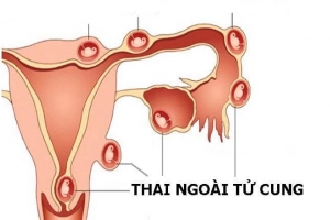 3 dấu hiệu điển hình của thai ngoài tử cung