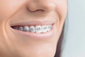 40 tuổi niềng răng được không?