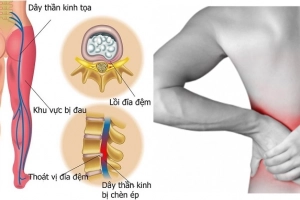 5 phút để biết cách phòng thoát vị đĩa đệm