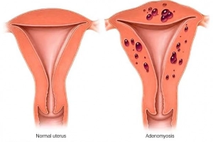 Adenomyosis là bệnh gì?