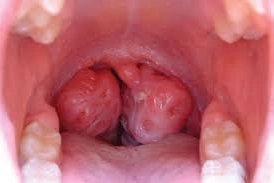 Amidan to, nổi đốm mụn có phải ung thư không?