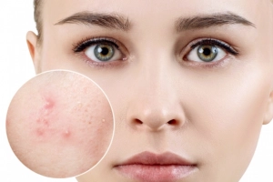 Ăn gì để hết mụn trứng cá? Lựa chọn thực phẩm tốt và loại bỏ thực phẩm xấu