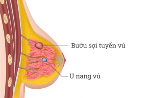 Ảnh hưởng của bướu sợi tuyến