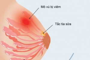 Áp xe vú điều trị như thế nào?