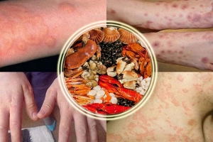 Bà bầu bị dị ứng hải sản phải làm sao?