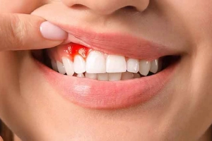 Bà bầu bị sưng lợi phải làm sao cho hết?