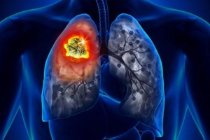 Bài 1: Hiểu rõ về ung thư phổi