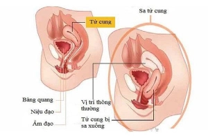 Bài tập tốt cho người sa tử cung