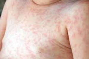 Ban sởi mọc như thế nào?
