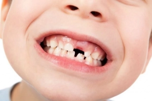 Bé răng nhổ lâu mọc lại, có cần đi khám?