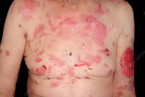 Bệnh bọng nước dạng PEMPHIGUS: Dấu hiệu, nguyên nhân và cách điều trị