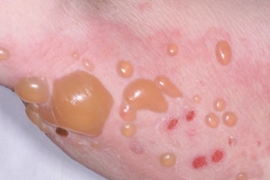 Bệnh bóng nước dạng Pemphigus trên da có chữa được không?