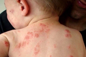 Bệnh chốc lở dùng thuốc gì?