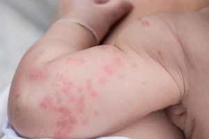 Bệnh đậu mùa có nguy hiểm không?