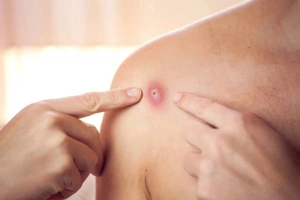 Bệnh đậu mùa khỉ có dấu hiệu gì?