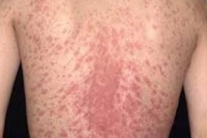 Bệnh đỏ da toàn thân: Đặc điểm, phân loại và cách điều trị