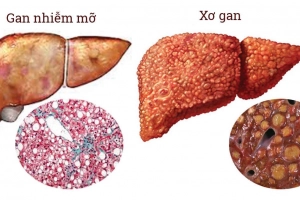 Bệnh gan nhiễm mỡ ở trẻ em và những điều cha mẹ cần biết