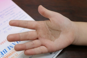 Bệnh nấm đen là gì?