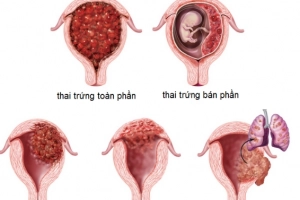 Bệnh nguyên bào nuôi có mấy loại?