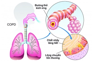 Bệnh phổi tắc nghẽn COPD và ung thư phổi