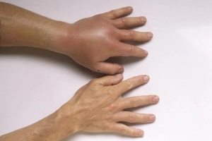 Bệnh phù mạch di truyền: Nguyên nhân, chẩn đoán và điều trị