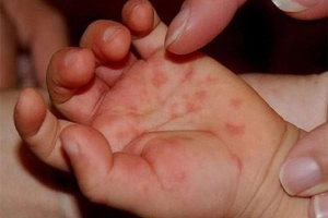 Bệnh tay chân miệng bội nhiễm: Bóng nước chuyển từ trong sang đục