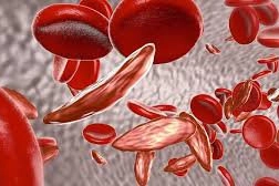 Bệnh thiếu máu Thalassemia (tan máu bẩm sinh)