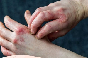 Bệnh tiểu đường loại 2 và sức khỏe da