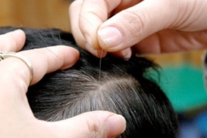 Bệnh tóc bạc sớm ở trẻ em