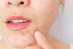 Bệnh trứng cá đỏ là bệnh gì?