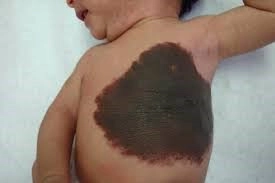 Bệnh u sắc tố bẩm sinh ở trẻ em