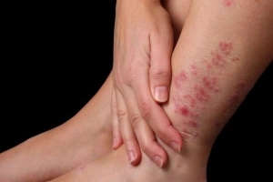 Bệnh vảy nến mặc vải gì? 10 lời khuyên để chọn quần áo và giường ngủ phù hợp với bệnh vẩy nến