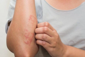 Bệnh vảy phấn hồng gibert: Dấu hiệu lâm sàng và chẩn đoán điều trị