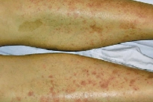 Bệnh viêm mạch do IgA (xuất huyết Schonlein Henoch)