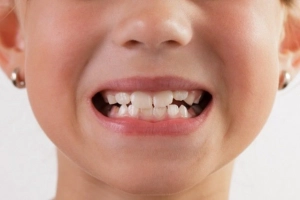 Bệnh viêm quanh răng (viêm nha chu) điều trị như thế nào?
