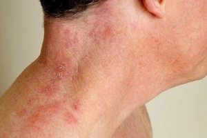 Bệnh Zona thần kinh có chữa khỏi được không?