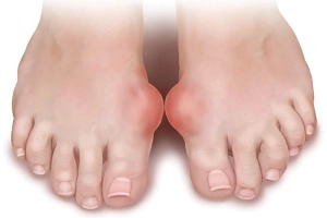 Bị bệnh gút ăn trứng được không?