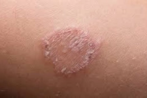 Bị bệnh hắc lào và cách chữa hiệu quả