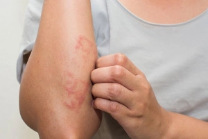 Bị dị ứng thời tiết bôi thuốc gì?