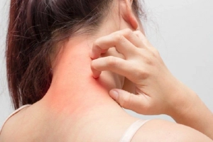 Bị dị ứng thời tiết nên kiêng gì?