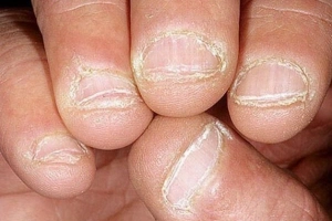 Bị nấm móng tay bôi thuốc gì?