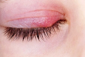 Bị ngứa mi mắt liên tục, coi chừng viêm bờ mi