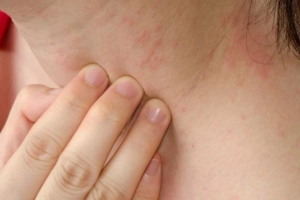Bị nổi mẩn ngứa khắp người không rõ nguyên nhân