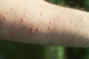 Bị nổi mề đay kiêng gì để giảm mẩn ngứa?