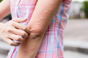Bị nổi mề đay liên tục, kéo dài, phải làm sao?