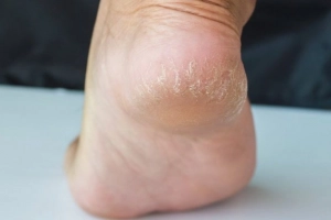 Bị nứt gót chân là thiếu chất gì?