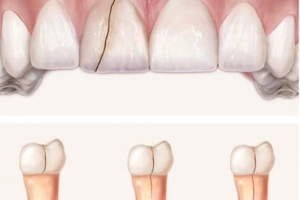 Bị nứt răng có nguy hiểm và có tự lành không?