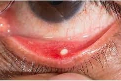 Bị sạn vôi mắt có tự khỏi không?